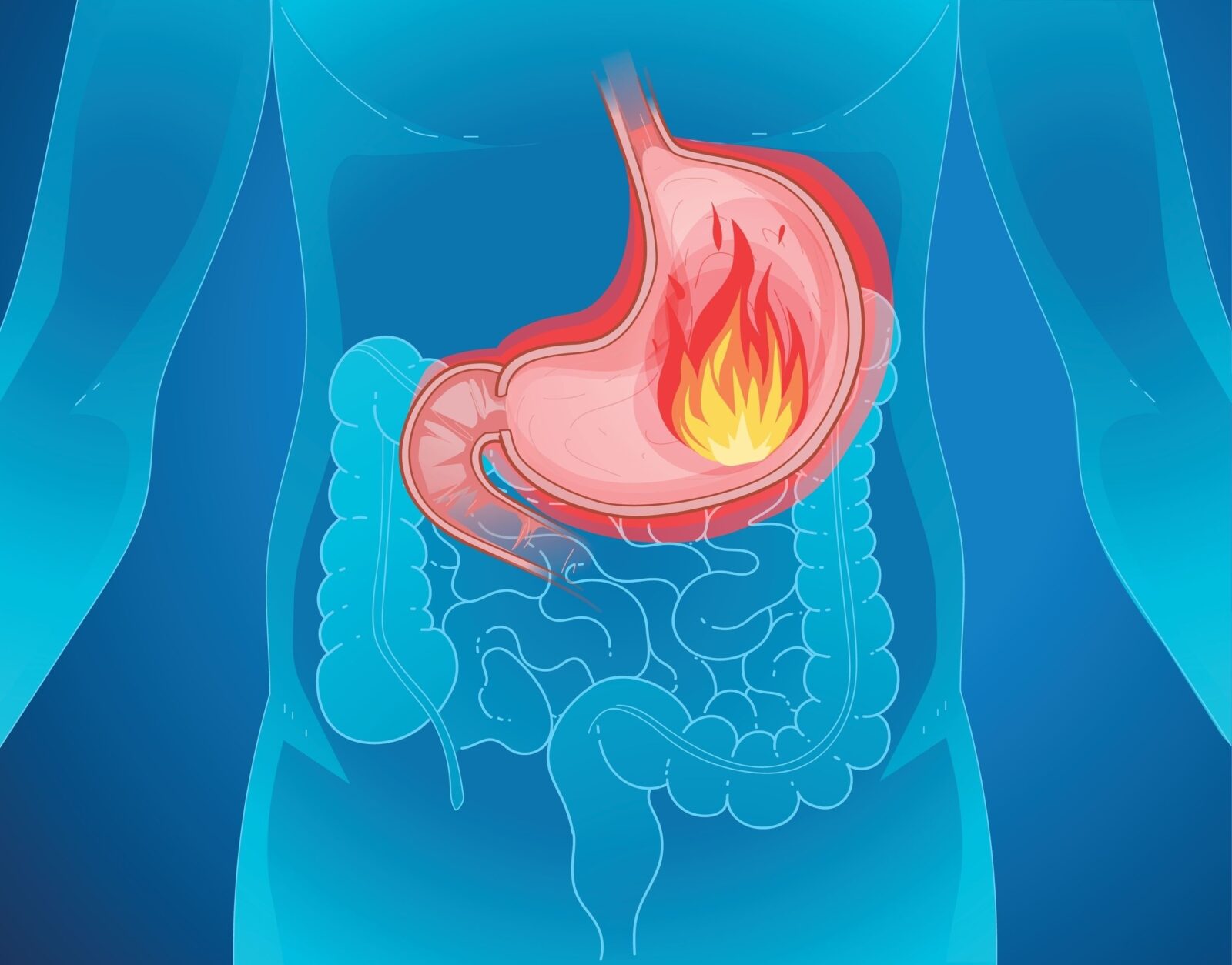 Image of heartburn